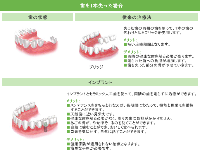 歯を1本失った場合