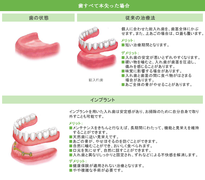 歯をすべて失った場合