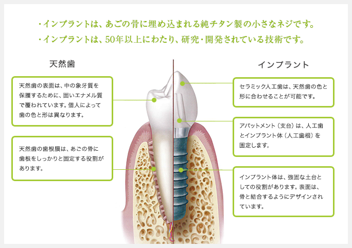 インプラントの構造